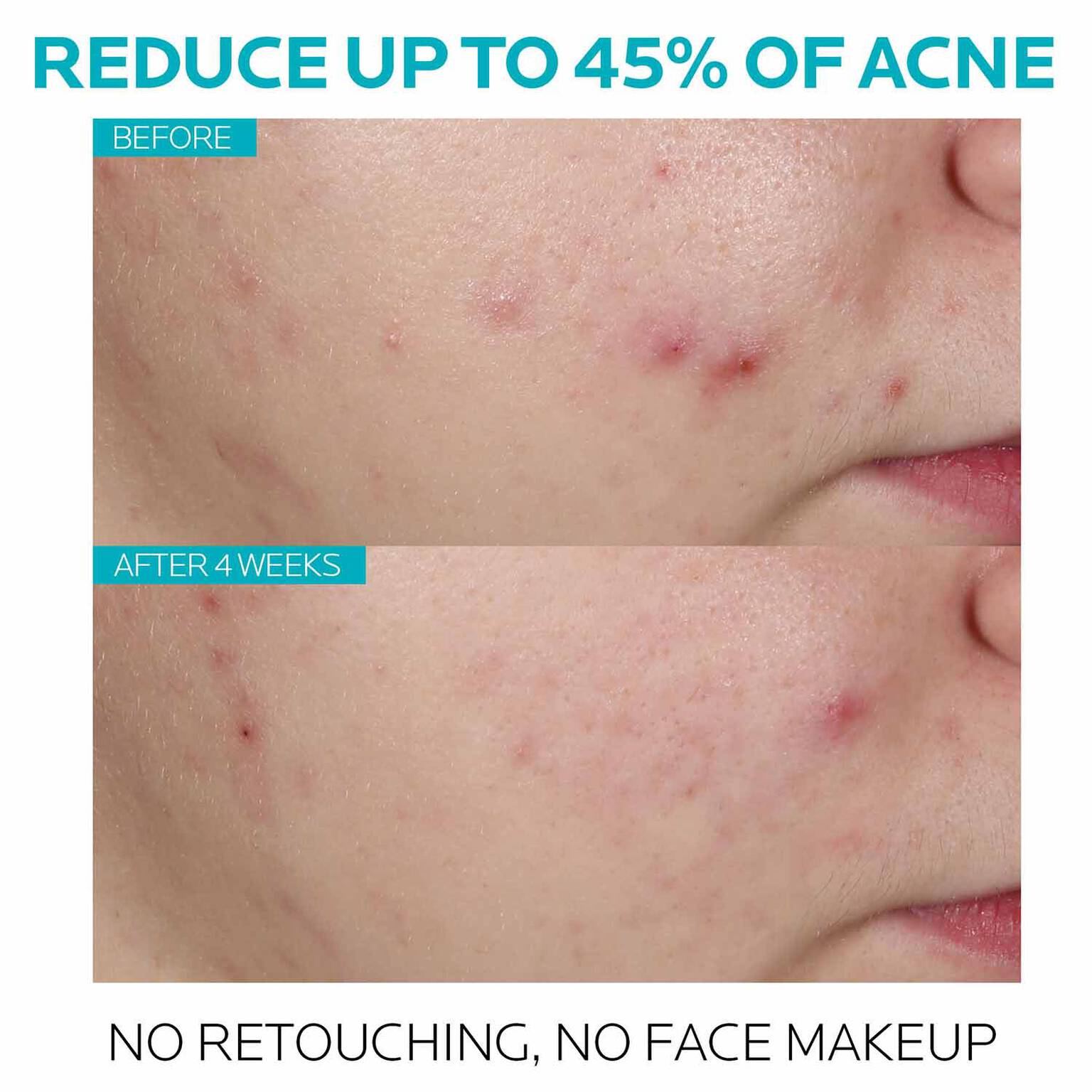 effaclar-salicylic-acid-acne-treatment-serum-u9 7_EffaclarSerum_After-45-days.jpg