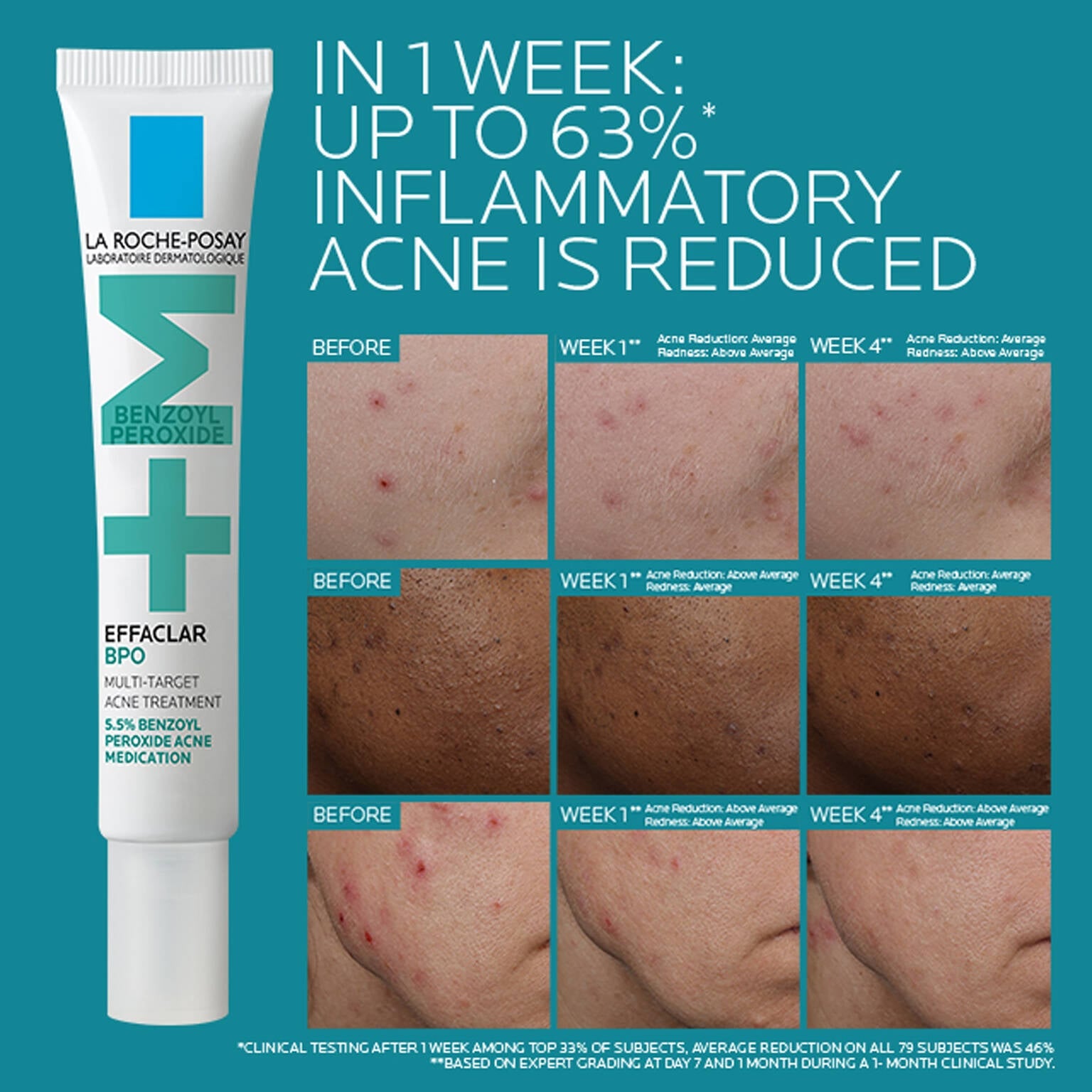effaclar-bpo-multi-target-acne-treatment-with-5-5-benzoyl-peroxide-b8 EffaclarBPO-ClinicalBA-ATF-1500x1500-2.jpg