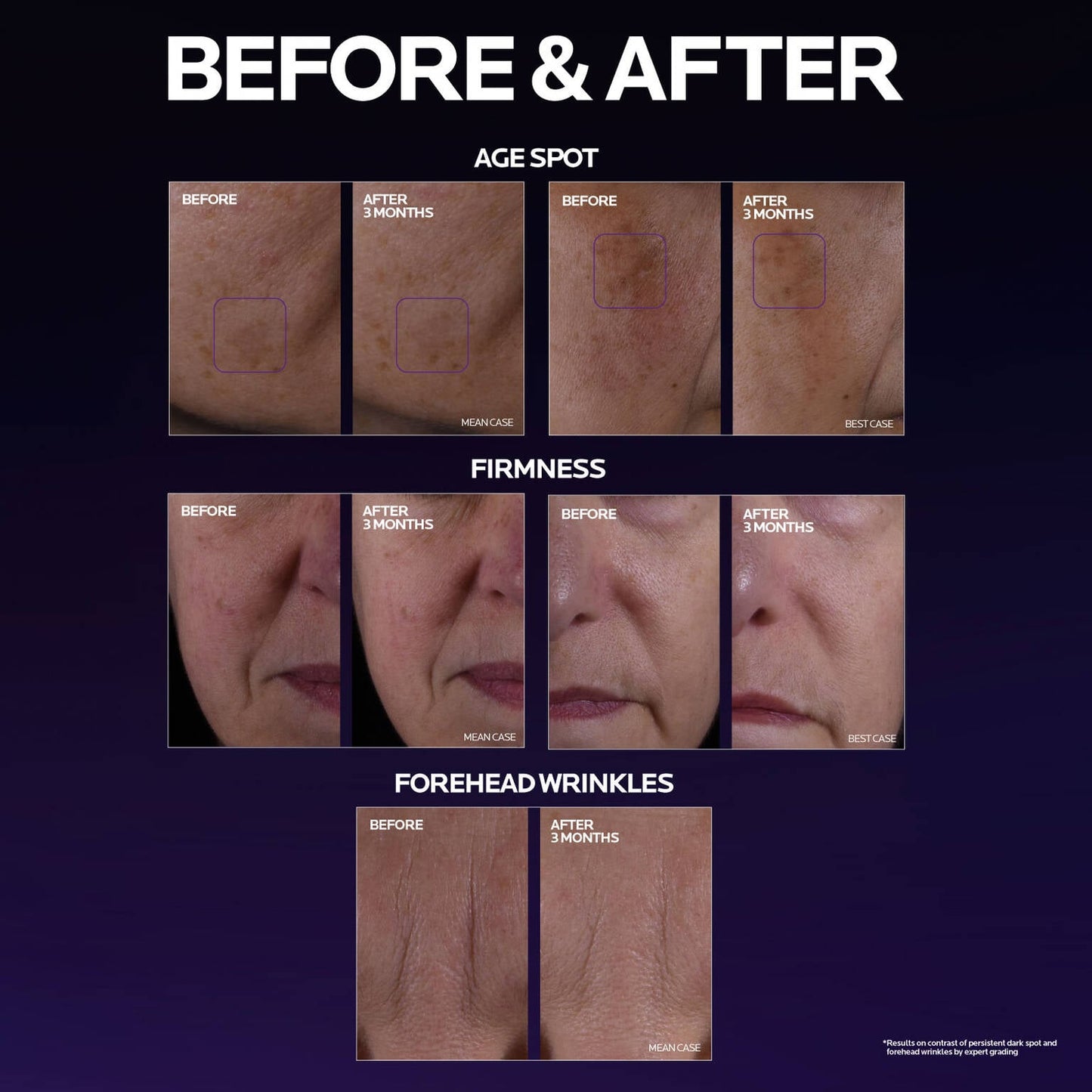 mela-b3-double-dose-discoloration-treatment-with-melasyltm-a9 MelaB3_DD_BTF_BeforeAfter_1500x1500_5.jpg