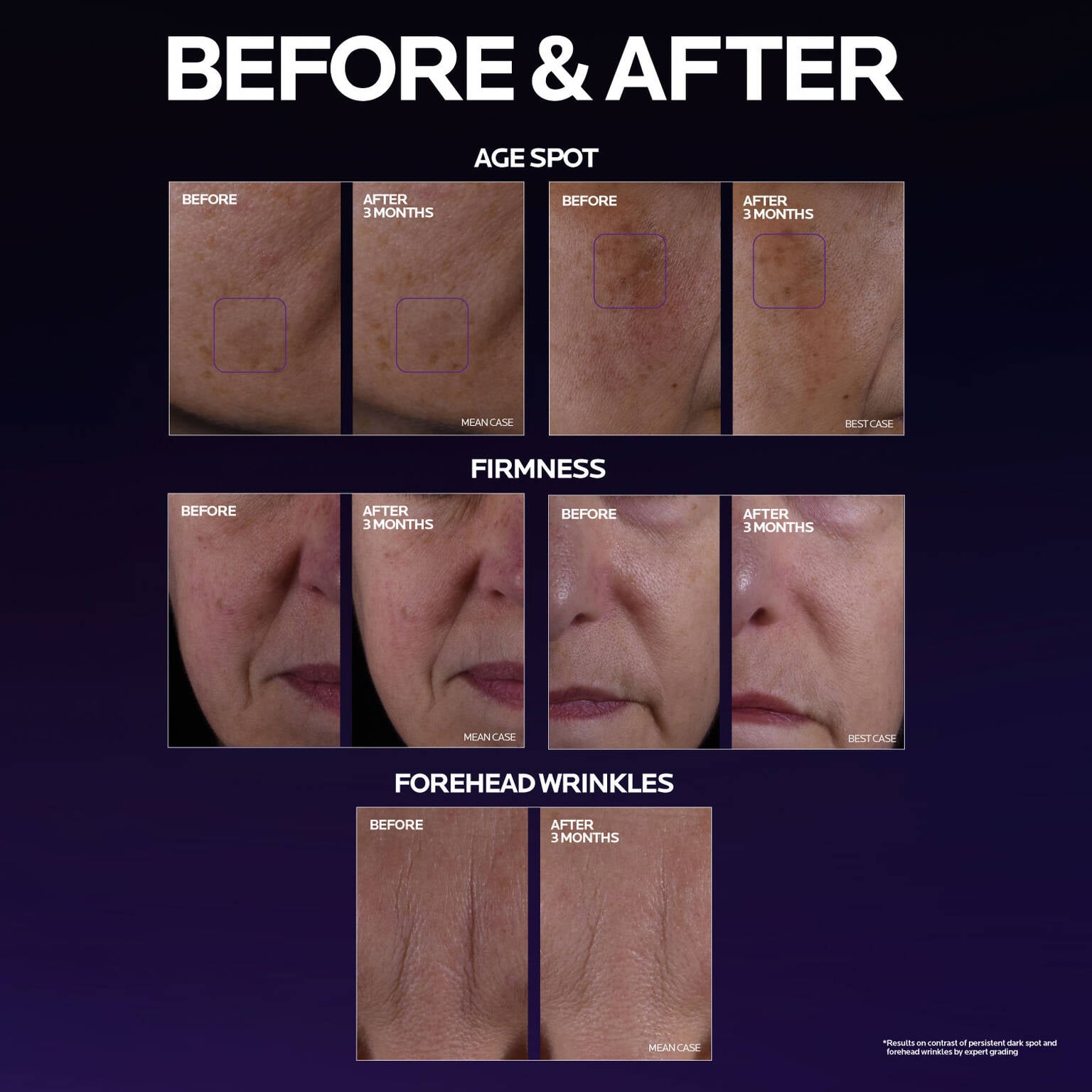 mela-b3-double-dose-discoloration-treatment-with-melasyltm-a9 MelaB3_DD_BTF_BeforeAfter_1500x1500_5.jpg